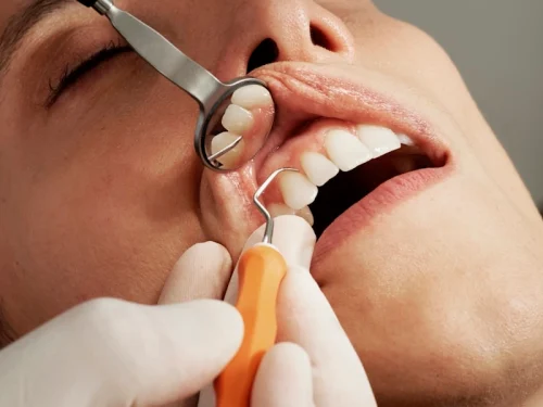 Dental-Bonding.webp