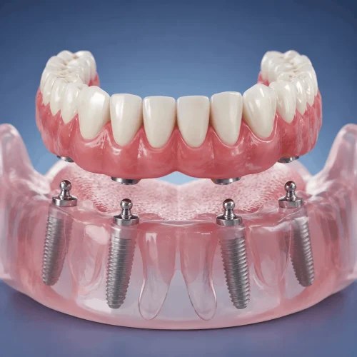 Implant-Supported Dentures Added Stability and Confidence - Dean Park Dental